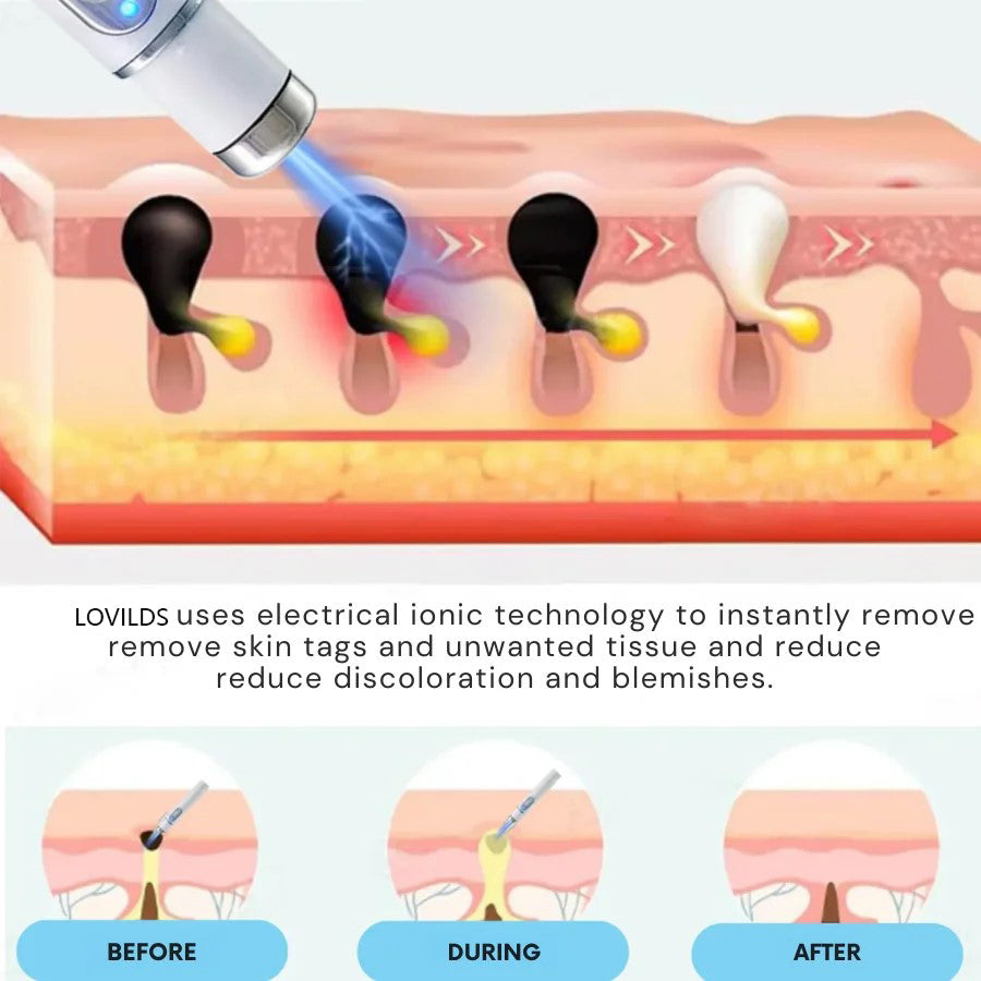 đĽăOFFICIAL STOREăLOVILDS⢠Non-Invasive Mole and Wart Removal Laser Pen
