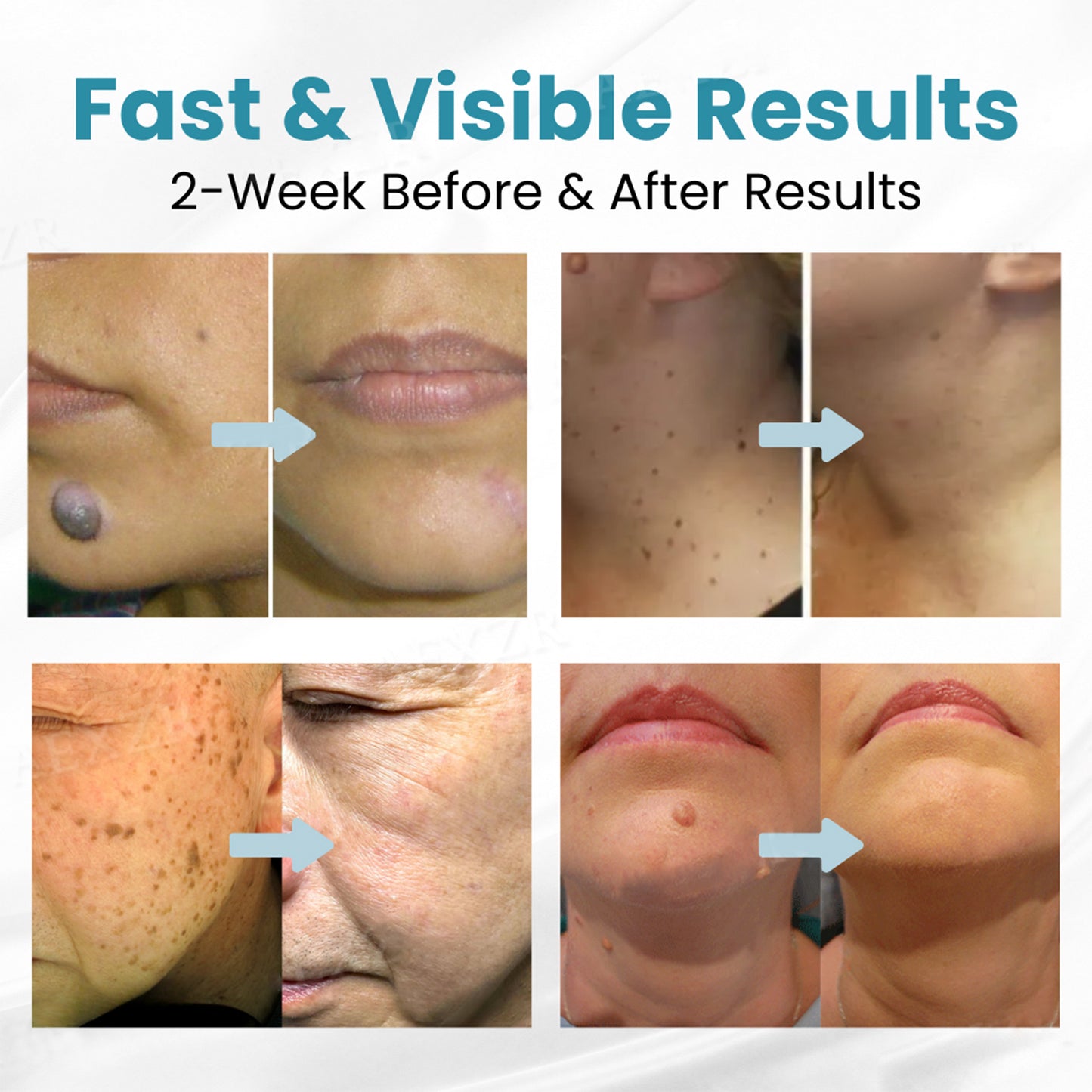 đĽăOFFICIAL STOREăLOVILDS⢠Non-Invasive Mole and Wart Removal Laser Pen