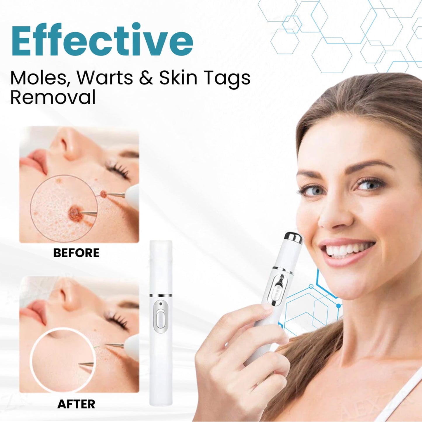 đĽăOFFICIAL STOREăLOVILDS⢠Non-Invasive Mole and Wart Removal Laser Pen